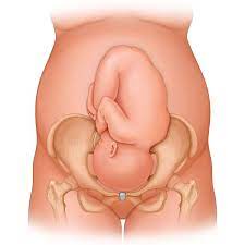 Right occiput anterior